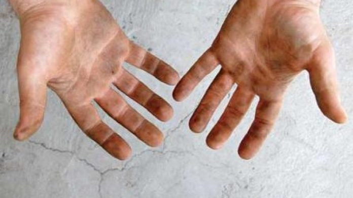 hepatită virală A hepatită virală A